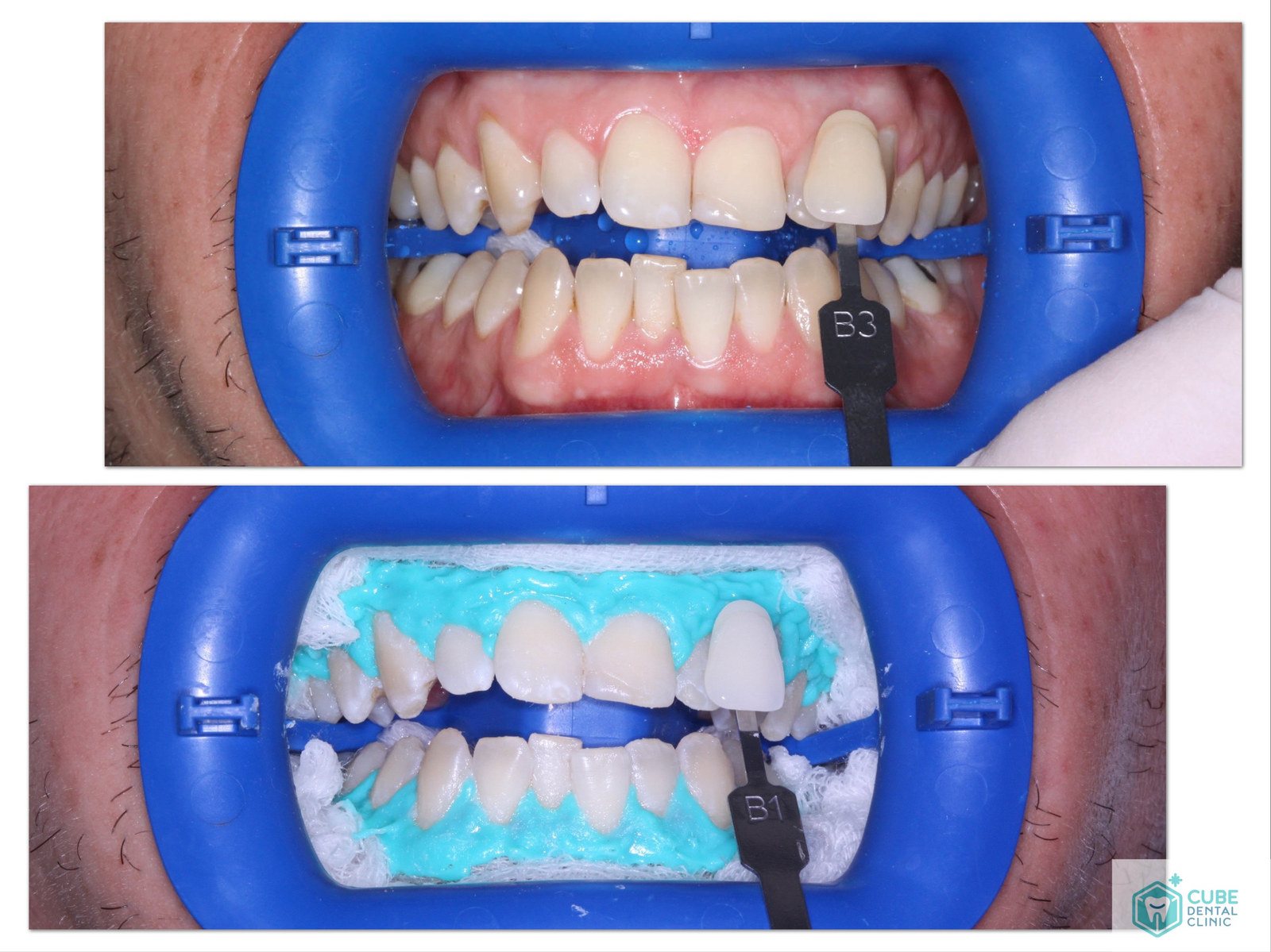 What helps with comfort after dental surgery